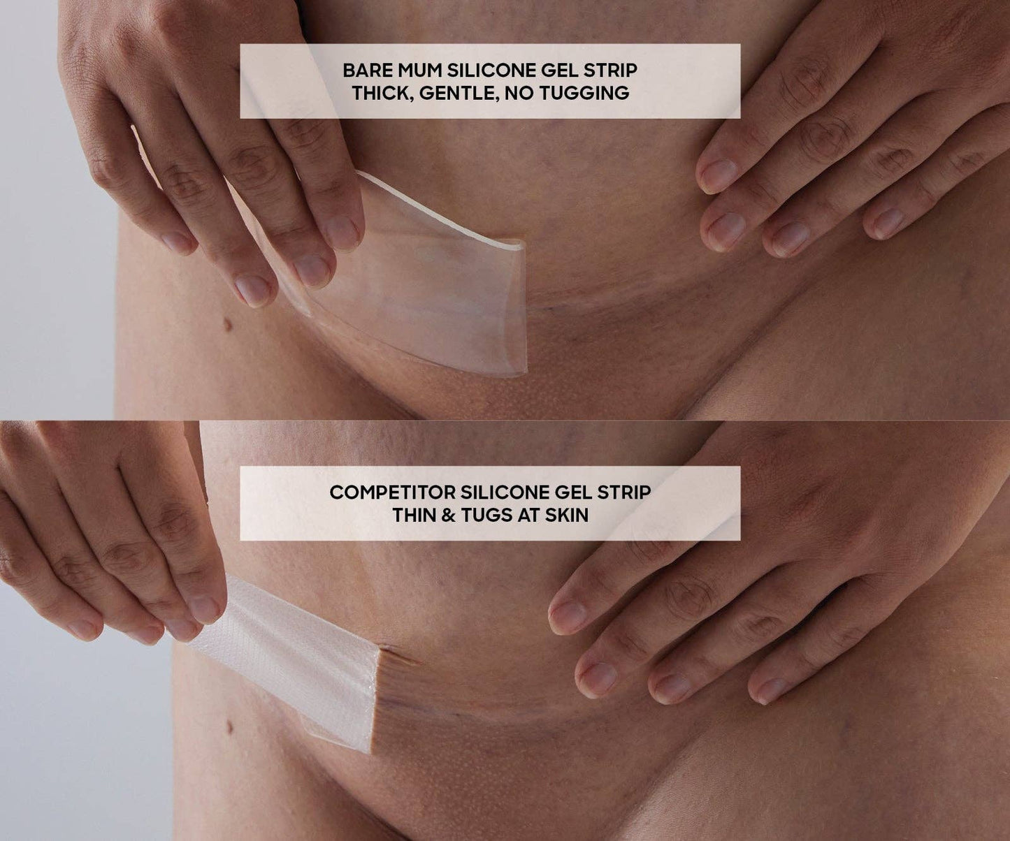 Bare Mum - Silicone Gel Scar Strips