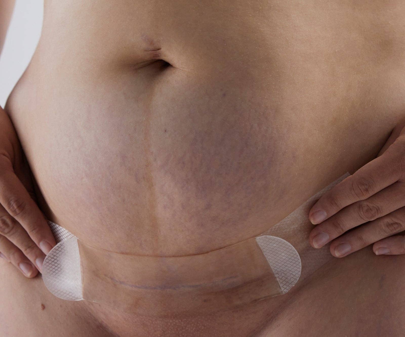 Image of Bare Mum - Silicone Gel Scar Strips